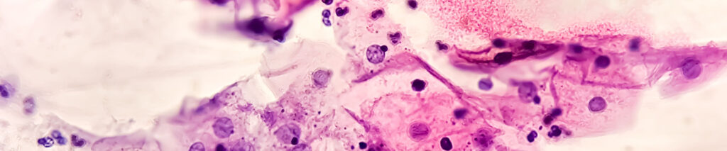 Abnormal Pap Smears